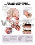 Chronic Obstructive Pulmonary Disease (COPD) Anatomical Chart, 1st Edition